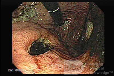 Rak żołądka - endoskopowa ocena śluzówki żołądka