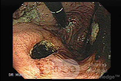 Rak żołądka - endoskopowa ocena śluzówki żołądka