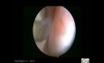 Endometriose- die totale vaginale Länge (tvl)