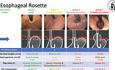 Rôle de l'Endoscopie Préopératoire en Chirurgie Bariatrique
