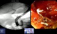 Dominando el CBD distal: la maniobra de "bulbo restringido" para una EPLBD segura.