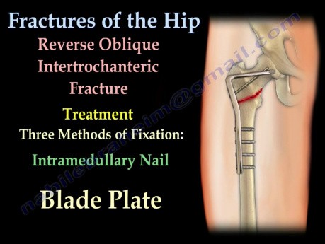 Złamania w obrębie biodra i sposoby ich leczenia