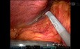 Robotic Cholecystectomy for Necrosed, Abscessed, and Perforated Cholecystitis