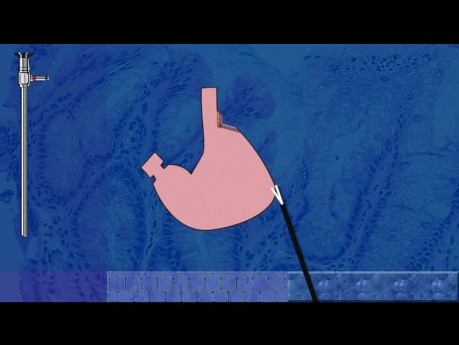 Laparoskopowa plastyka żołądka Wedge-Collisa podczas fundoplikacji 360º i operacji przepukliny rozworu przełykowego