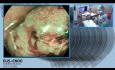 Staging przed resekcją - badanie endoskopowe oraz ERUS (ultrasonografia endorektalna)