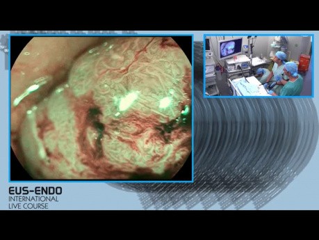 Staging przed resekcją - badanie endoskopowe oraz ERUS (ultrasonografia endorektalna)