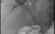 Endoskopowa choledochoduodenostomia pod kontrolą EUS [5/7]