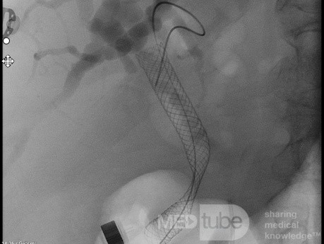 Endoskopowa choledochoduodenostomia pod kontrolą EUS [5/7]