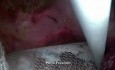 Operacja przepukliny pooperacyjnej - metoda SILS