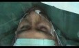 Przeszczep zastawki aortalnej u pacjenta przytomnego (w znieczuleniu epiduralnym)
