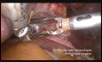 Totalna histerektomia laparoskopowa dla początkujących
