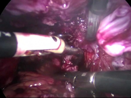 Całkowita laparoskopowa resekcja macicy z powodu endometriozy