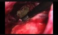 Laparoskopowa nekrosektomia trzustki