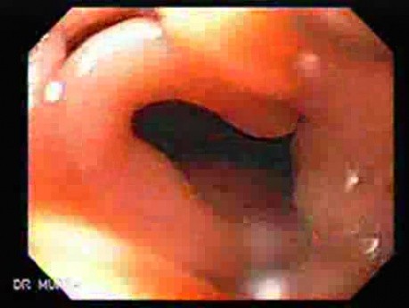 Nawrotowy rak żołądka po resekcji żołądka typu Billroth II (2 z 6)