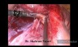 Laparoskopia w ropnym zapaleniu wyrostka robaczkowego