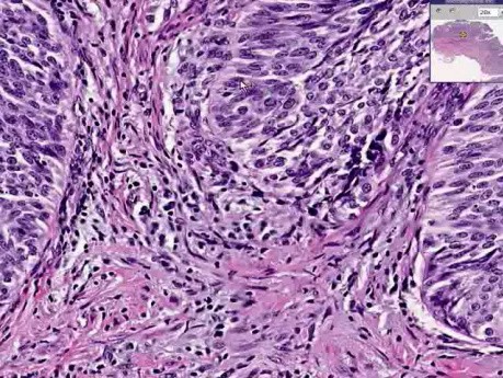Pęcherz moczowy - rak z komórek urotelialnych - Grade I