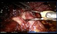 Rak płata środkowego płuca lewego - resekcja z użyciem robota