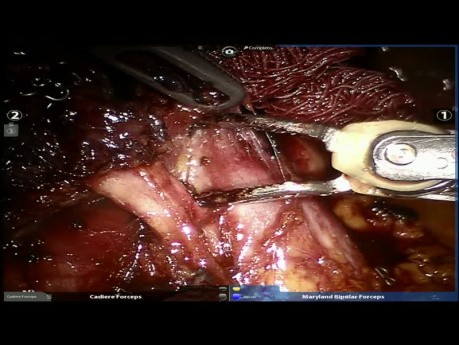 Rak płata środkowego płuca lewego - resekcja z użyciem robota