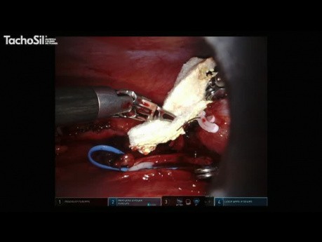 Zastosowanie TachoSil w urologicznych operacjach robotowych