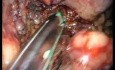 Laparo-endoskopowa jednomiejscowa (LESS) dystalna pankreatektomia i splenektomia