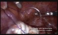 Laparoskopia z powodu olbrzymich endometrialnych torbieli jajnikowych (endometrioma)