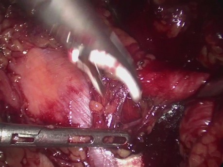 Laparoskopowe usunięcie węzłów chłonnych w przypadku nawrotu raka gruczołu krokowego
