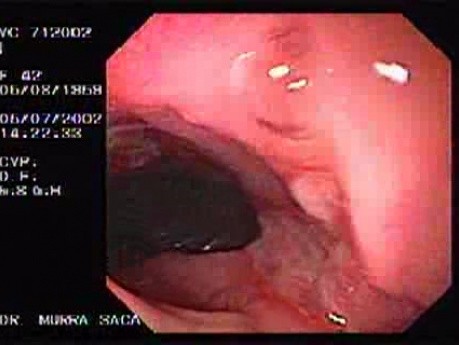 Choroba Leśniowskiego - Crohna - endoskopia (13 z 28)