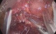 Hemicolectomía izquierda extendida laparoscópica colorrectal con escisión mesocólica completa y anastomosis colon transverso-rectal con desrotación del colon derecho para carcinoma de la flexura esplénica.