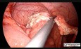 Appendektomia laparoskopowa u pacjenta pediatrycznego