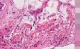 Przerzutowy rak piersi - histopatologia - serce, osierdzie