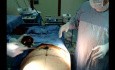 Operacja liposukcji - konturowanie ciała