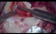 Metoda łączona (endoskopowa i mikroskopowa) w chirurgii perlaka 