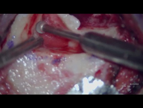 Metoda łączona (endoskopowa i mikroskopowa) w chirurgii perlaka 
