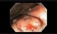 Kolonoskopia: endoskopowa resekcja śluzówkowa płaskiej zmiany w dolnej części odbytnicy