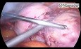 Laparoskopowa miomektomia z powodu dużego mięśniaka sródściennego 