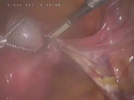 TLH - laparoskopowe usunięcie macicy z przydatkami