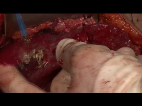 Chirurgiczne aspekty śluzaka rzekomego otrzewnej