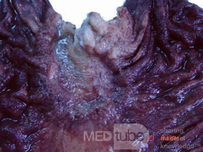 Gruczolakorak wpustu i dna żołądka z komórkami sygnetowatymi (17 z 25)