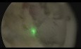 HoLEP – Laserowa Enukleacja Prostaty
