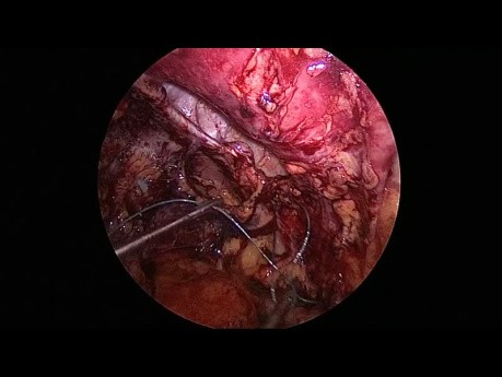 Operacja przepukliny lewostronnej L4 laparoskopową metodą przezbrzuszną przezotrzewnową