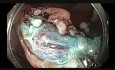 Kolonoskopia - EMR dużego guza kątnicy