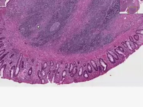 Wrzodziejące zapalenie jelita grubego, rak, atypia komórek - histopatologia - okrężnica
