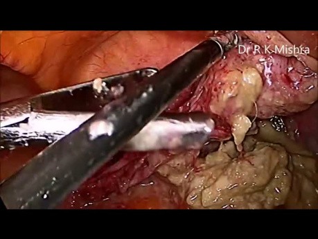 Laparoskopowa miomektomia i wyłuszczenie torbieli deroidalnej jajnika.