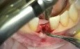 Mikrochirurgia implantologiczna: implantacja dolnego siekacza centralnego