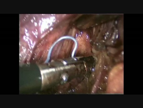 Laparoskopowa pankreatoduodenektomia z powodu nowotworu brodawki Vatera u otyłego pacjenta