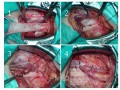 Przepuklina pachwinowa - operacja uszypułowanym płatem powięziowym