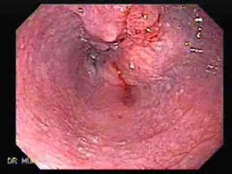 Rak płaskonabłonkowy przełyku - obecność guza na granicy między środkową a dolną częścią przełyku