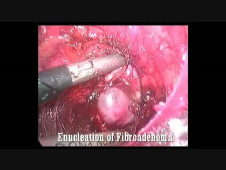 Endoskopowa resekcja wlókniakogruczolaka piersi