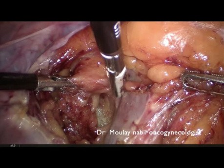 Chirurgia raka endometrium