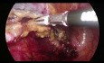 Laparoskopowa poszerzona hemikolektomia lewostronna (operacja Deloyersa)